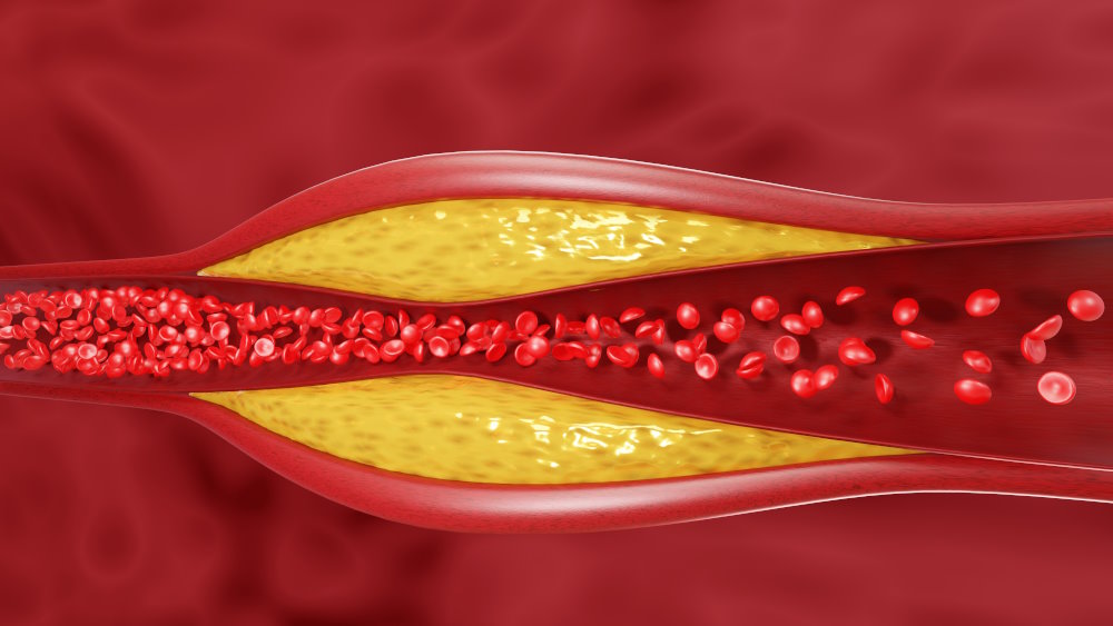 Arterie mit Cholesterin